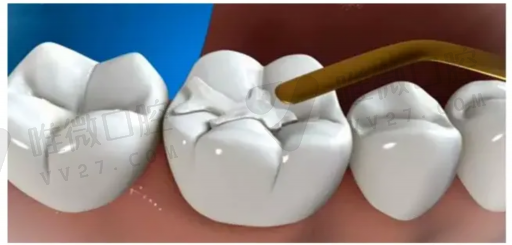 种植牙和安假牙有什么区别,为什么60岁后不种植牙(图1)